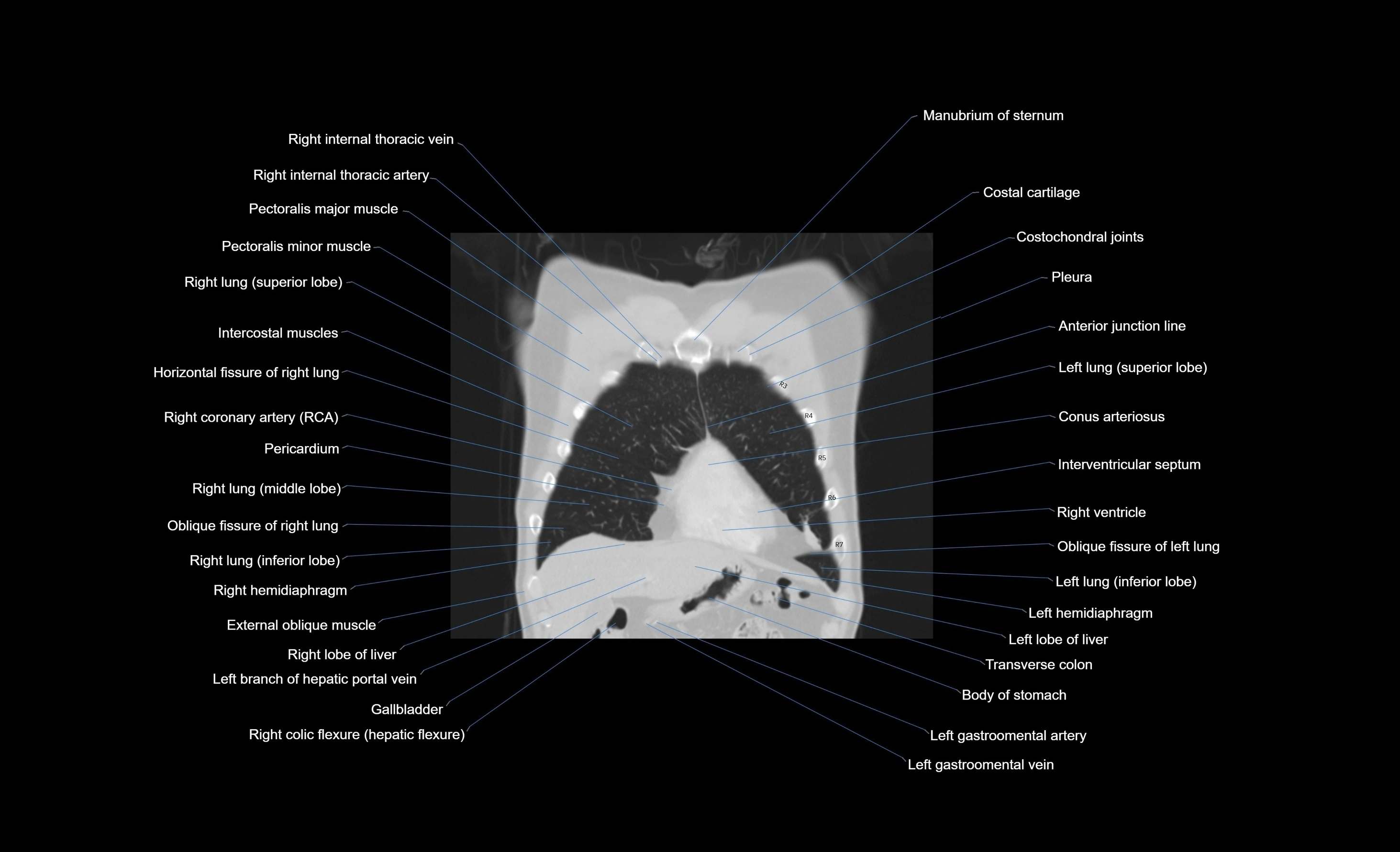 CT chest (thorax) labelled coronal cross sectional anatomy radiology image-00092.webp